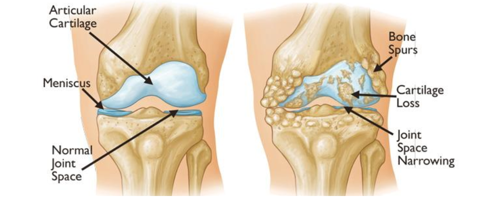 Arthritis