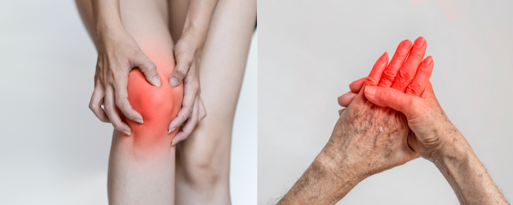 Arthritis